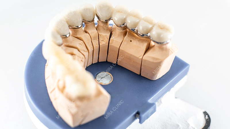 What Affects Dental Crowns Cost in Turkey
